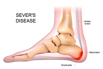Achilles tendonitis in child deals