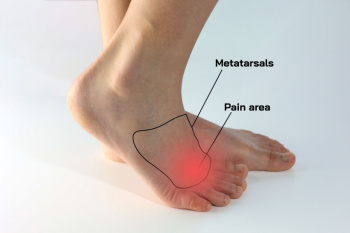 Best support deals for morton's neuroma