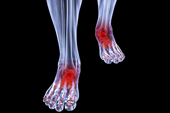 Arthritic foot care in the Hanover, PA area