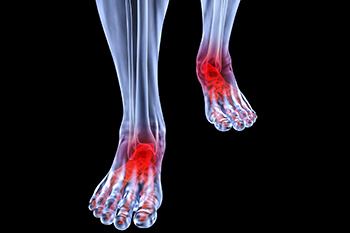 Arthritic foot care in the Hanover, PA area