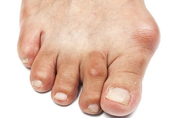 Bunions treatment in the Hanover, PA area