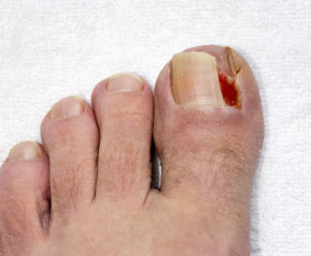 ingrown toenail treatment in the Hanover, PA area