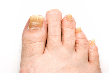 Toenail fungus treatment in the Hanover, PA area