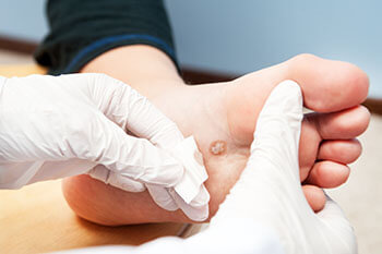 Warts treatment in the Hanover, PA area