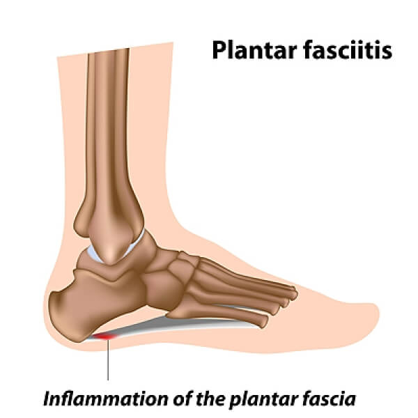 How You Can Treat Plantar Fasciitis at Home | OrthoBethesda