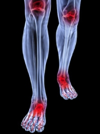 Psoriatic Arthritis and the Feet