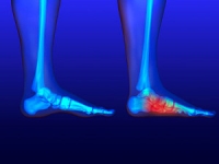 A Noticeable Sign of Flat Feet