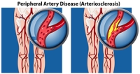 Effects of Peripheral Artery Disease on the Feet