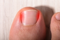 When Should My Child See a Doctor for Ingrown Toenails?