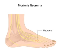 Possible Causes of Morton’s Neuroma